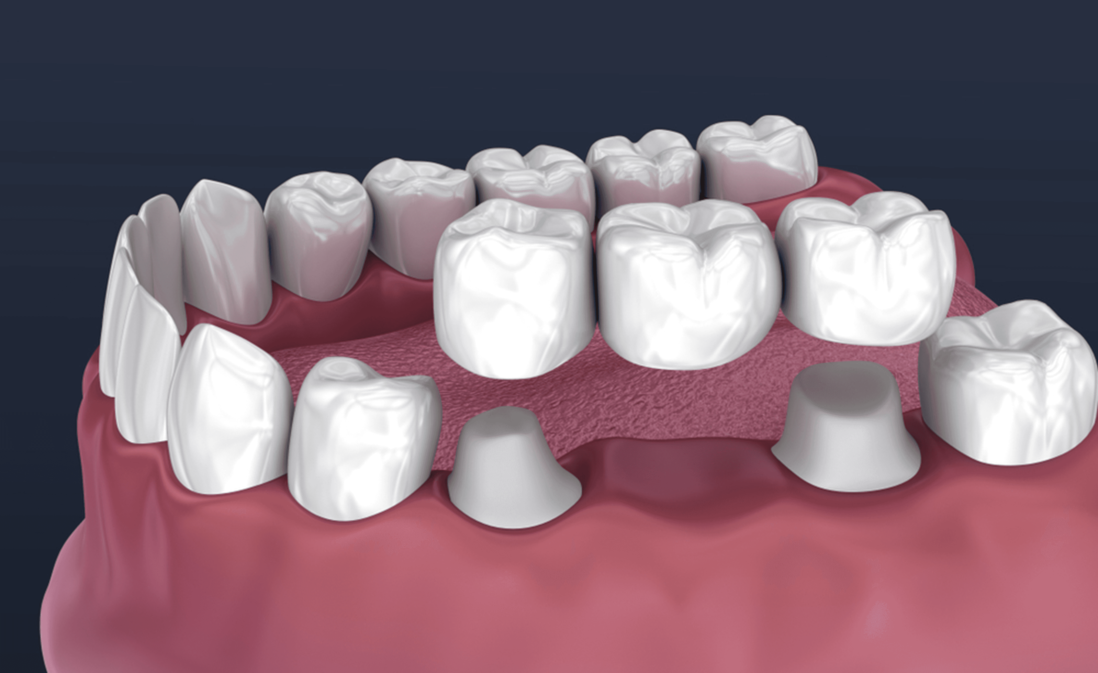 Dental Crowns & Bridges