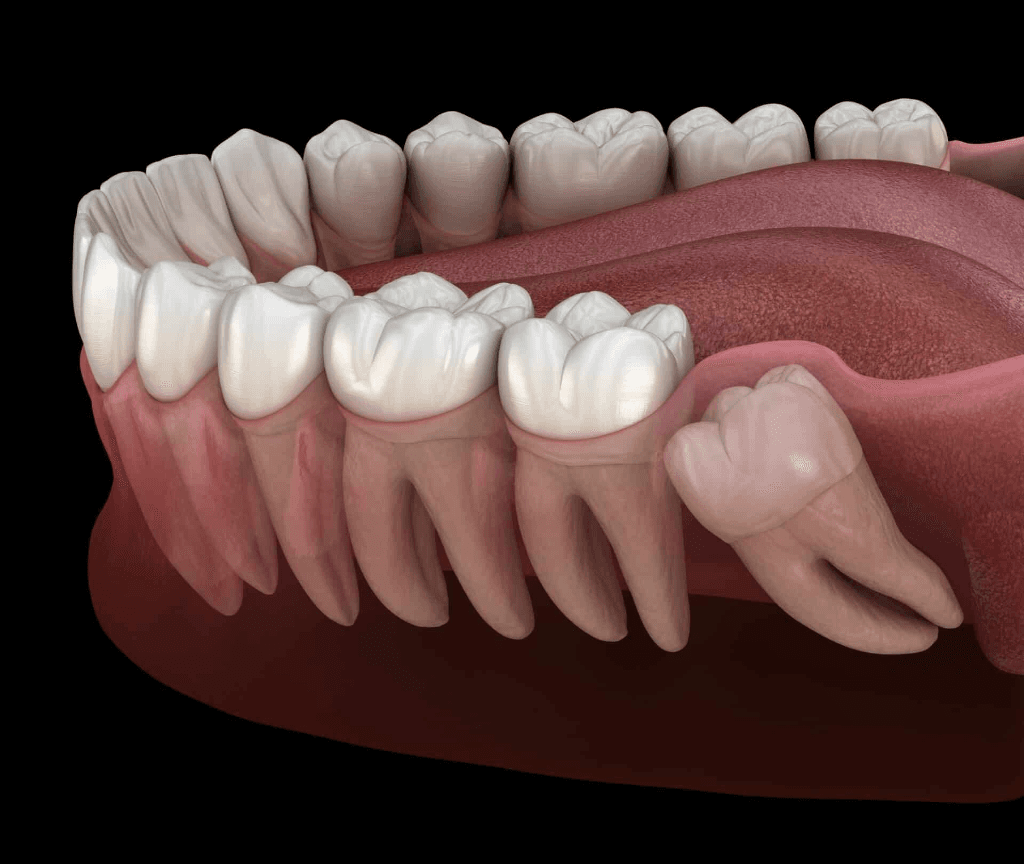 Wisdom Teeth